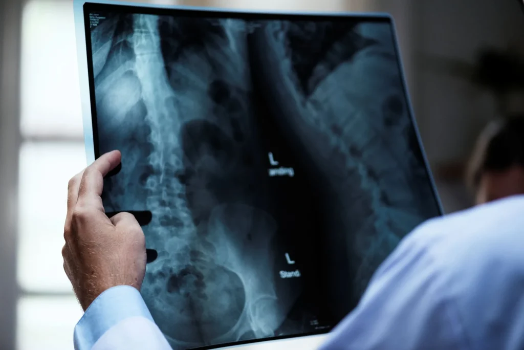 Osteoporose atinge homens e mulheres de maneira diferente; veja cuidados